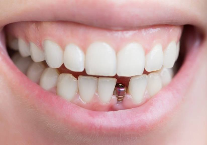 Smile with dental implant