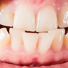 crooked teeth indicating the need for Candid clear aligners in Pantego