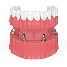 Dentures on implants