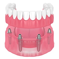 illustration of implant dentures for cost of dentures in Arlington  