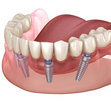 Diagram of an implant denture in Arlington
