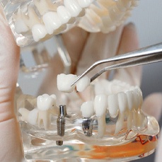Dentist covering dental implants in Arlington with a restoration