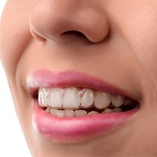 A woman wearing Invisalign aligners