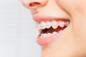 woman smiling wearing clear braces