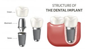 dental implant 3D illustration