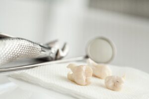 Extracted teeth lying on gauze beside dental tools.